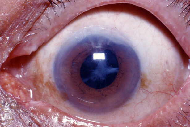 FAQs About Cataract Surgery