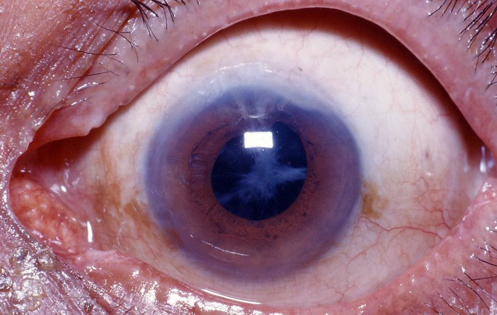 FAQs About Cataract Surgery