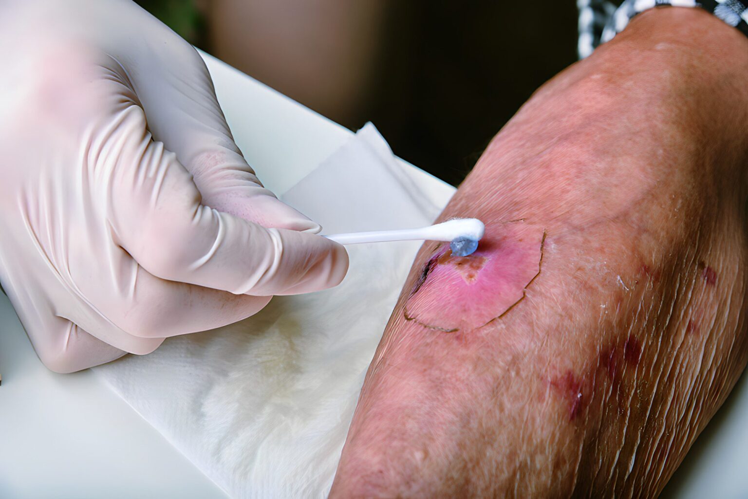 Best Practices for Wound Care After Surgery