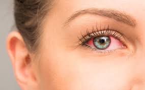 Common Allergies That Can Cause Red Eyes and How to Manage Them