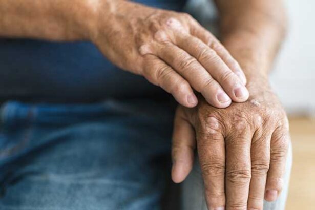 Common Questions About Psoriatic Arthritis Treatments