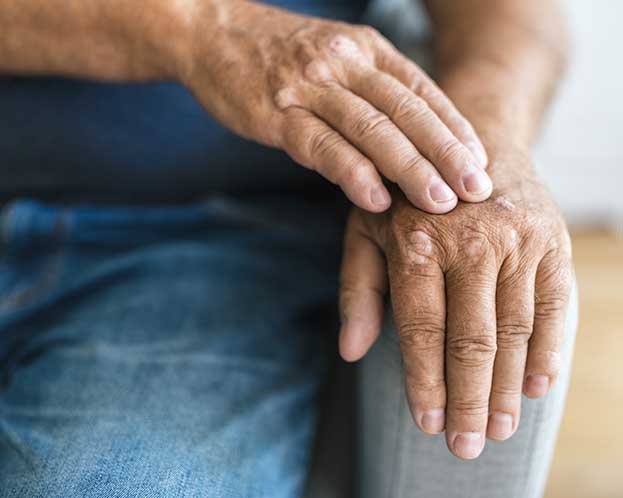 Common Questions About Psoriatic Arthritis Treatments