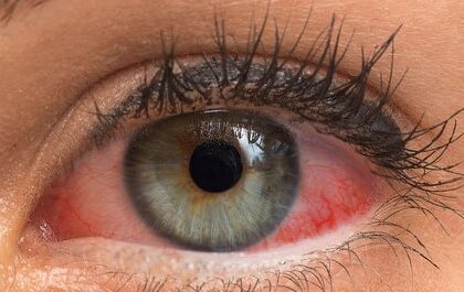 Exploring the Different Types of Red Eye Conditions