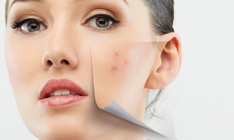 How Chemical Peels Can Help With Acne Scars