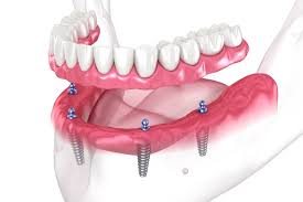 How a Dental Implant Specialist Can Enhance Your Smile