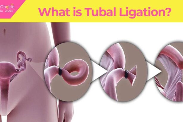 Is Tubal Reversal Right for You? Factors to Consider