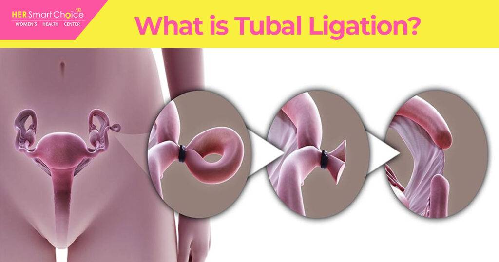 Is Tubal Reversal Right for You? Factors to Consider