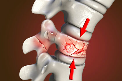 Long-term Benefits of Kyphoplasty for Osteoporotic Fractures