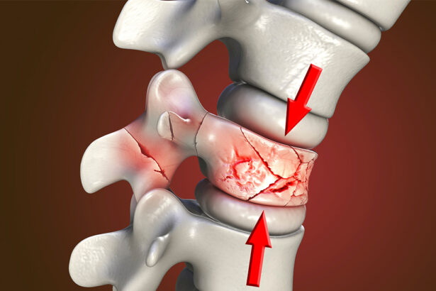 Long-term Benefits of Kyphoplasty for Osteoporotic Fractures