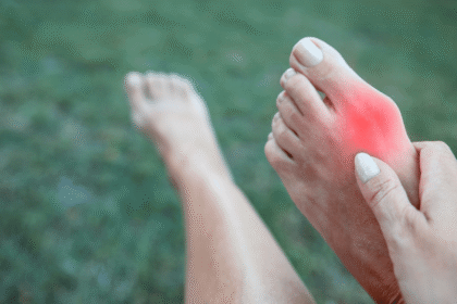 Surgical Options for Severe Bunions: What to Expect
