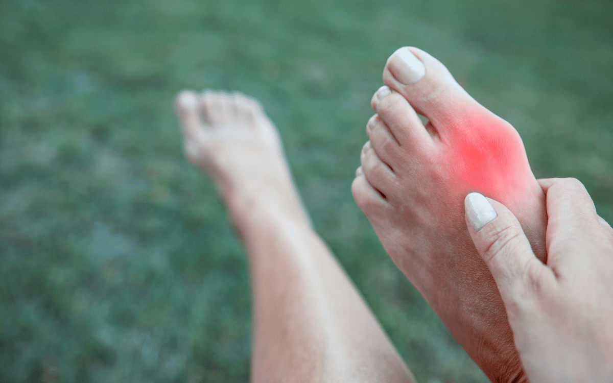 Surgical Options for Severe Bunions: What to Expect