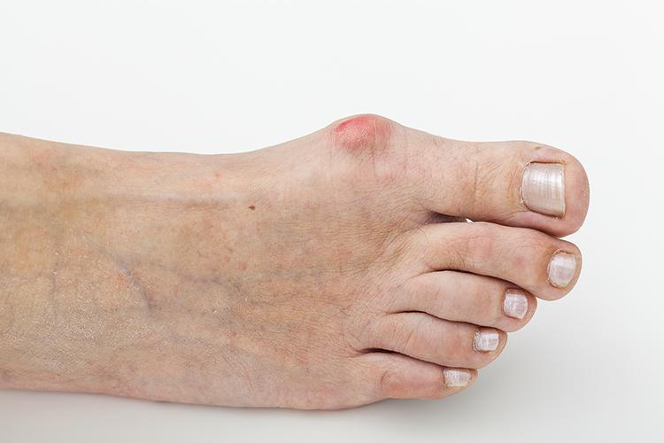 The Impact of Bunion Surgery on Daily Life