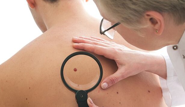 Tips for Skin Cancer Prevention