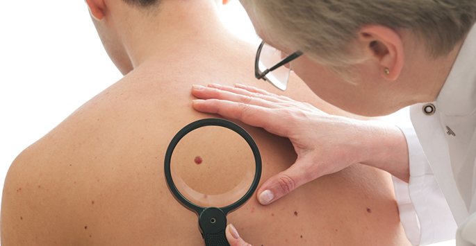 Tips for Skin Cancer Prevention