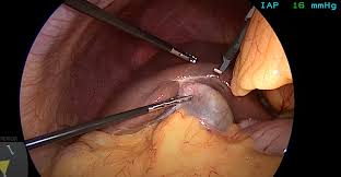 Understanding Laparoscopic Surgery for Gallbladder Removal