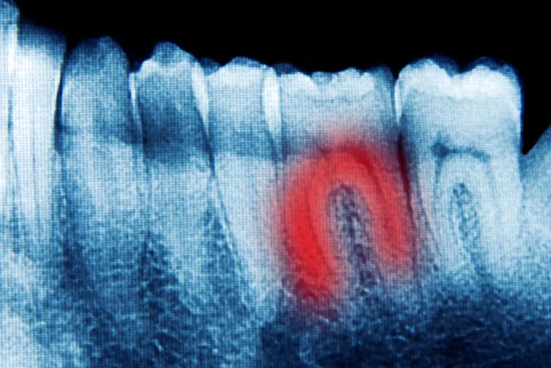 Understanding the Apicoectomy Procedure