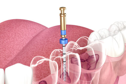 What Are Endodontic Implants and How Do They Work?