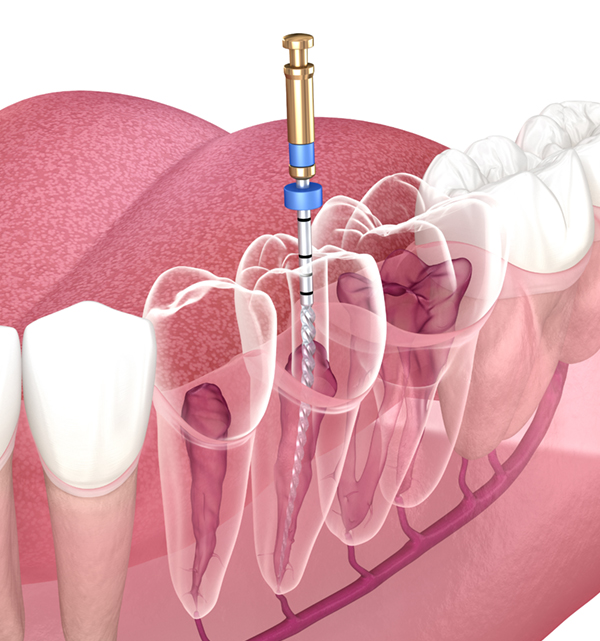 What Are Endodontic Implants and How Do They Work?