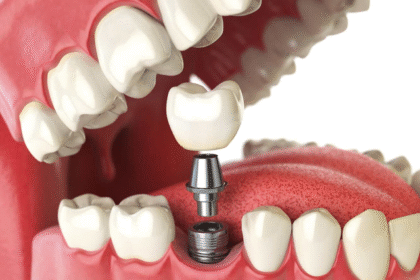 How Modern Dental Implants Improve Everyday Life
