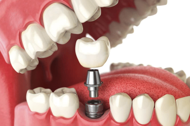 How Modern Dental Implants Improve Everyday Life
