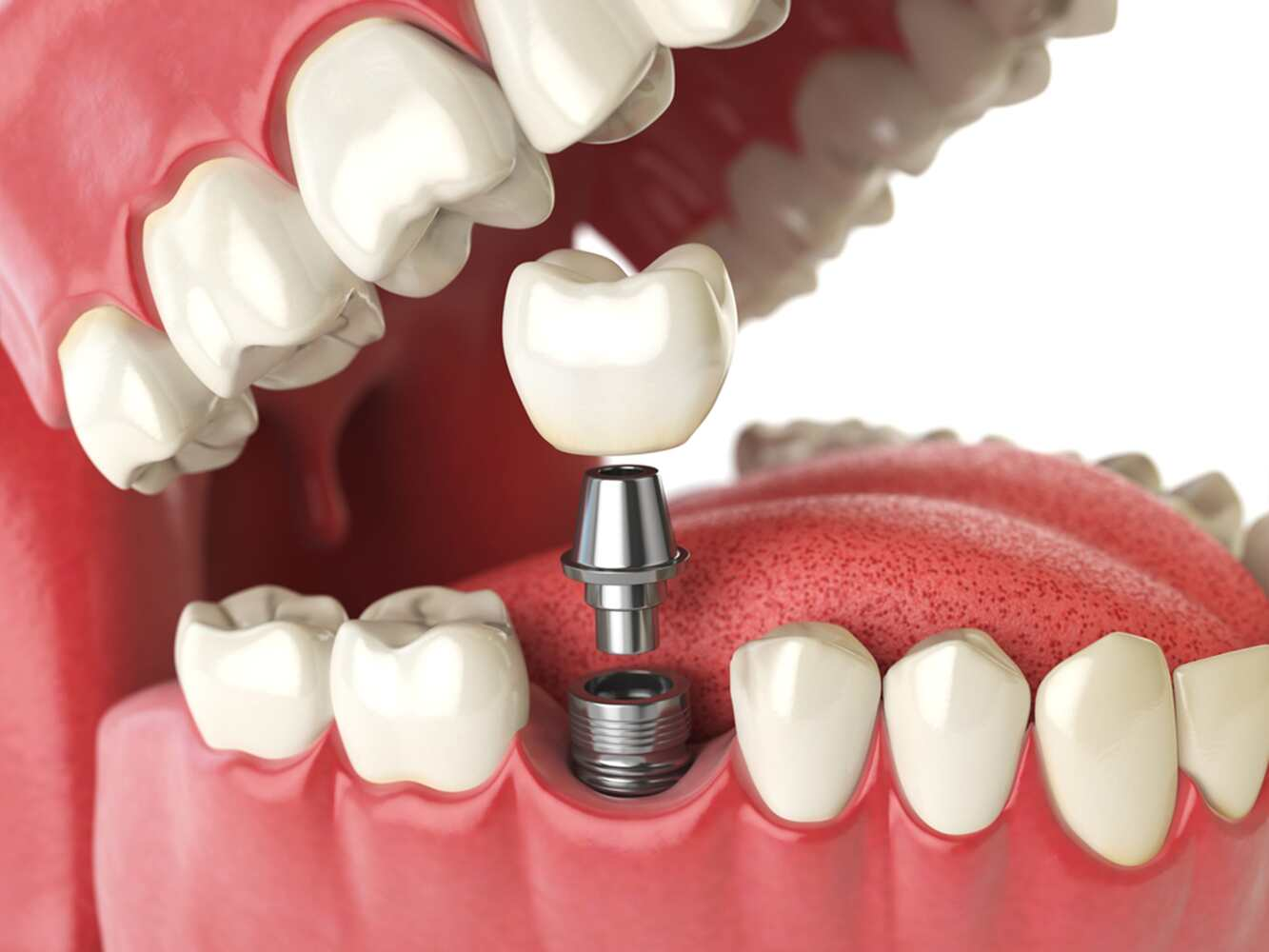 How Modern Dental Implants Improve Everyday Life