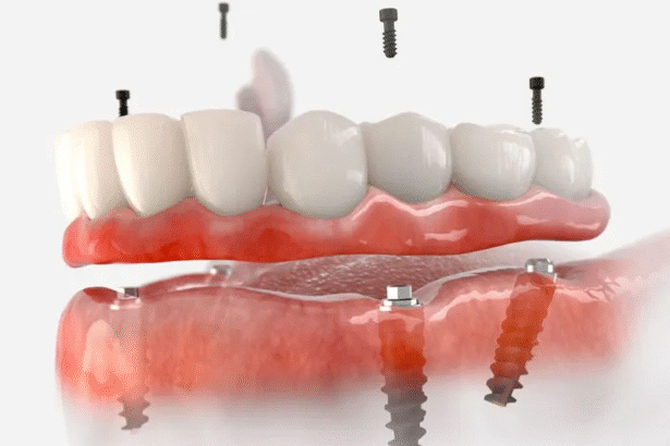 How Dental Implants Are Transforming Oral Health Care