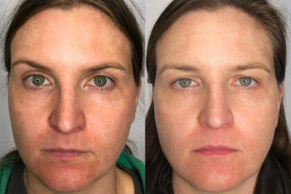 Laser Genesis Versus Traditional Laser Treatments