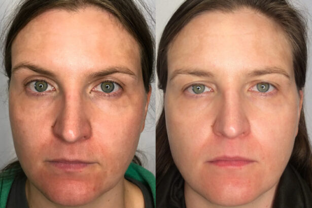 Laser Genesis Versus Traditional Laser Treatments