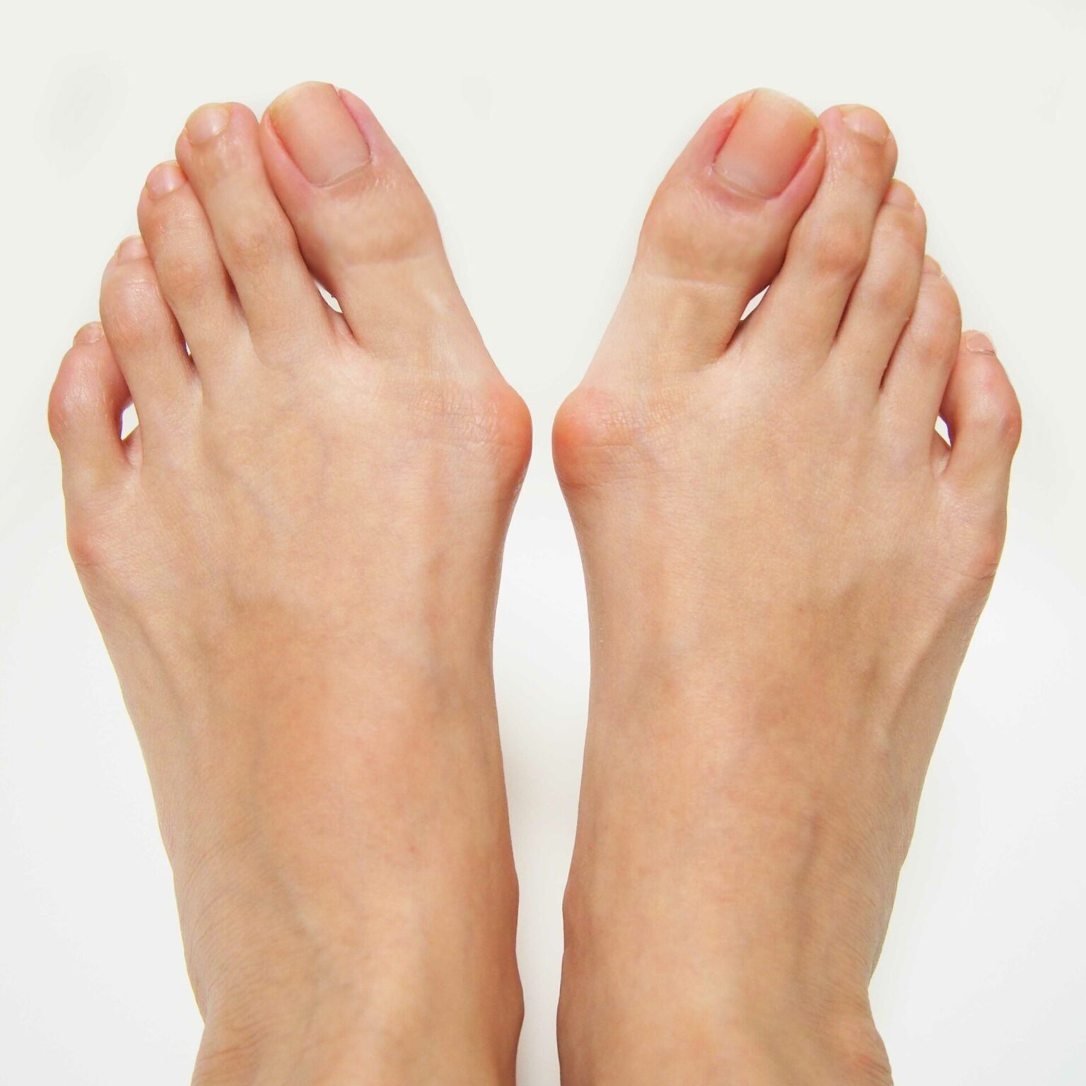 Nonsurgical Treatments for Bunions