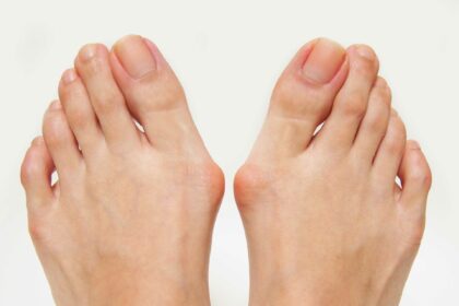 Nonsurgical Treatments for Bunions