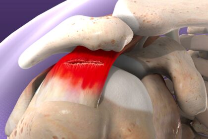 Recognizing the Signs of a Rotator Cuff Tear