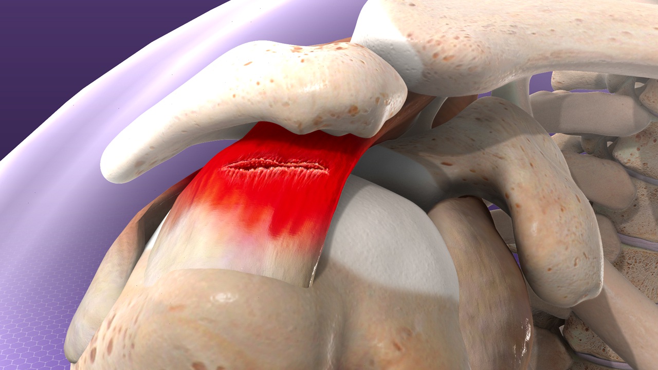 Recognizing the Signs of a Rotator Cuff Tear