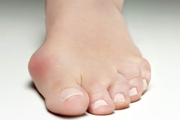 Symptoms, Causes, and Treatments for Bunions