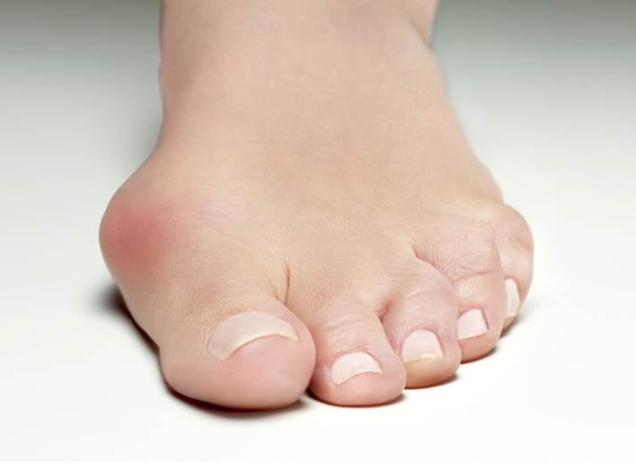 Symptoms, Causes, and Treatments for Bunions