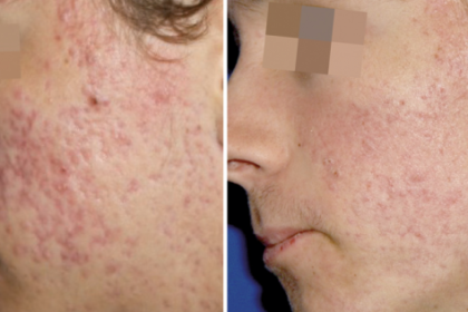 The Benefits PRP for Acne Scars