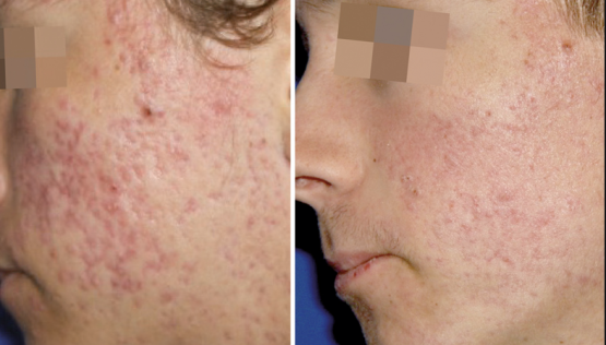 The Benefits PRP for Acne Scars