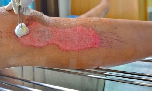 Tips For Managing Pain in Wound Care