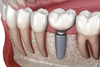 Understanding the Different Types of Fillings Available