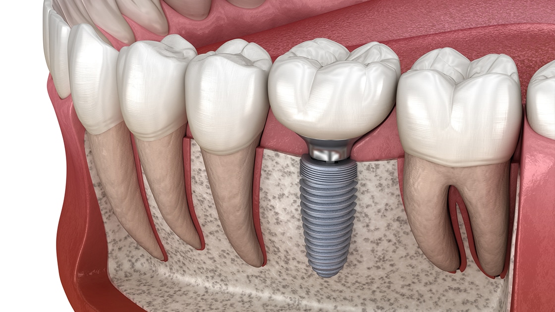 Understanding the Different Types of Fillings Available