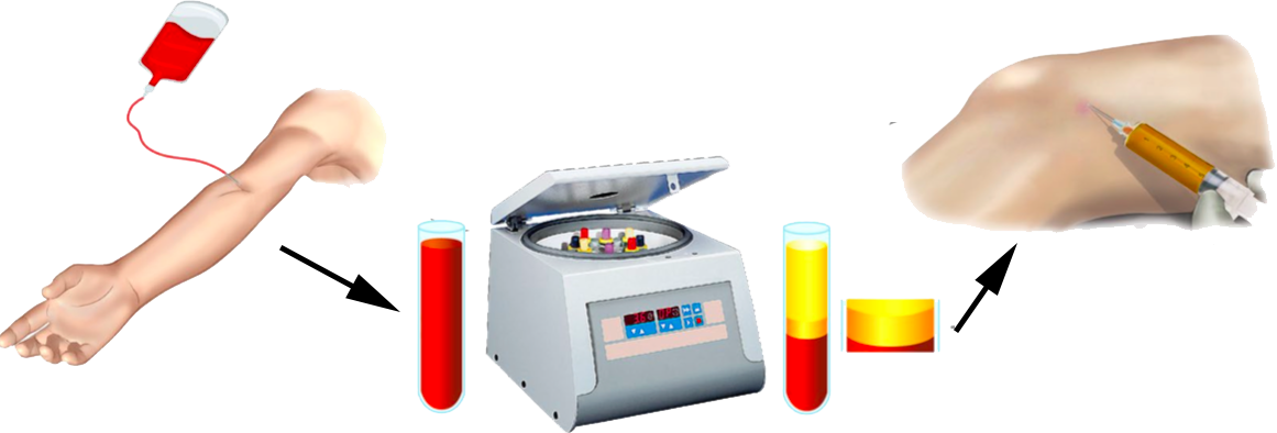 Understanding the Role of PRP in Tissue Regeneration