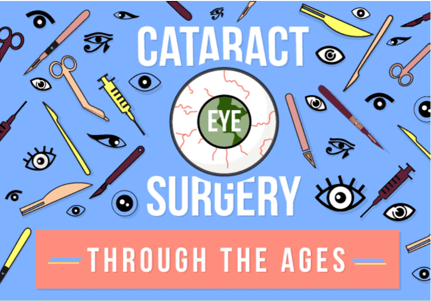 What to Expect Before, During, and After Cataract Surgery