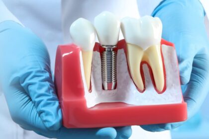 Who Should Get a Dental Implant?