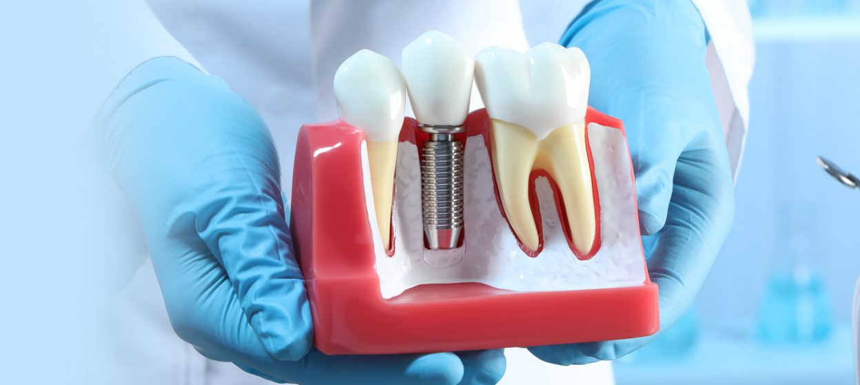 Who Should Get a Dental Implant?