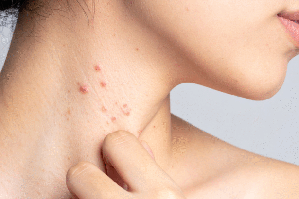 How Dermatology Can Help with Skin Disorders Beyond Acne