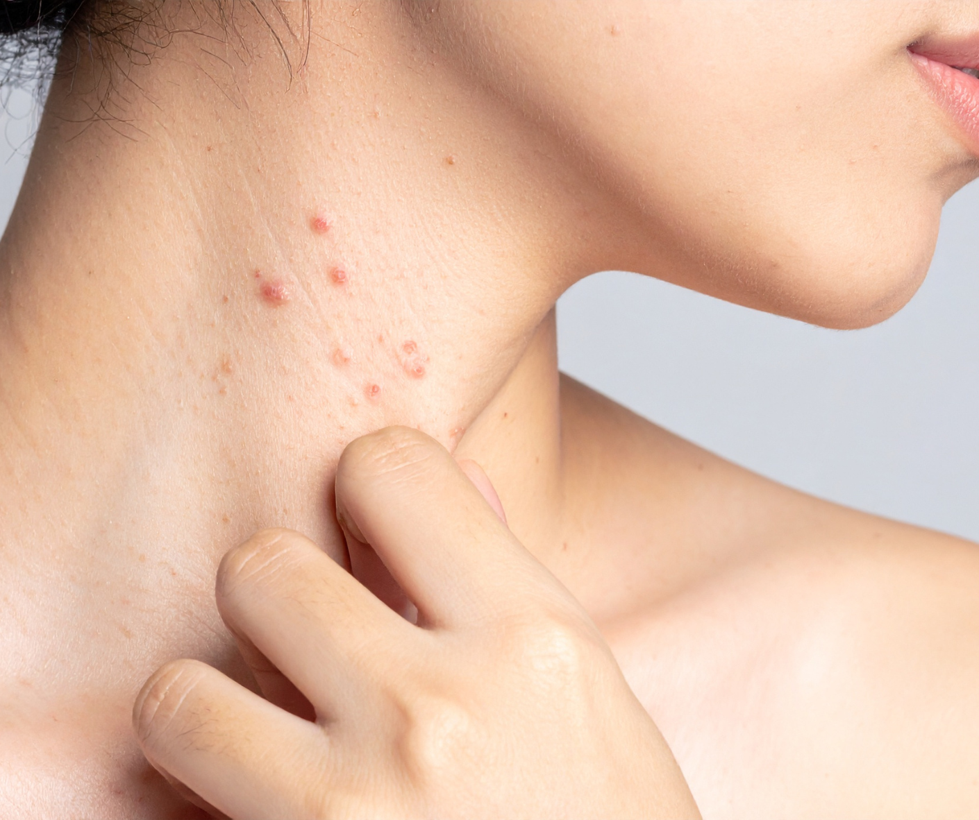 How Dermatology Can Help with Skin Disorders Beyond Acne