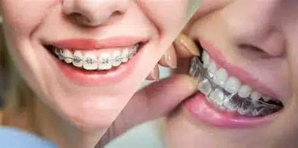 Invisalign Versus Traditional Braces
