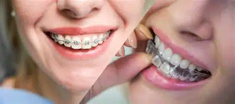 Invisalign Versus Traditional Braces