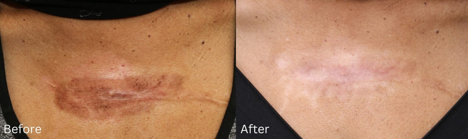 Long-Term Solutions for Scar Correction Post-Surgery