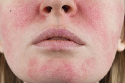 Understanding Common Skin Conditions Treated in Dermatology