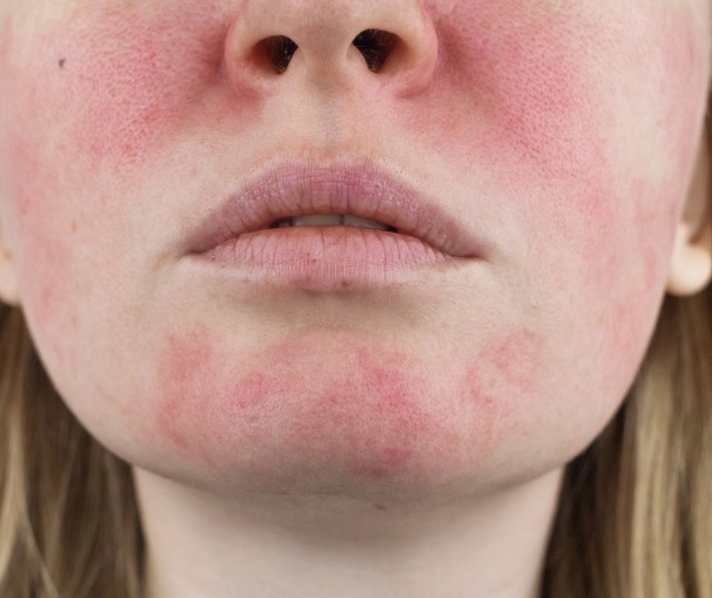 Understanding Common Skin Conditions Treated in Dermatology